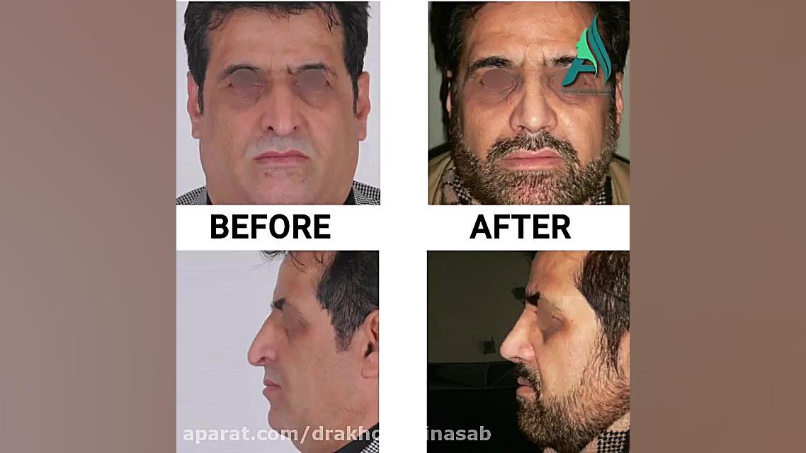 جراحی بینی مردانه دکتر محمدرضا آخوندی نسب-فوق تخصص جراحی پلاستیک