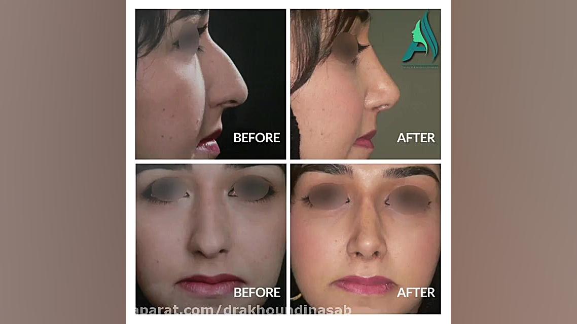 جراحی بینی طبیعی دکتر محمدرضا آخوندی نسب-فوق تخصص جراحی پلاستیک