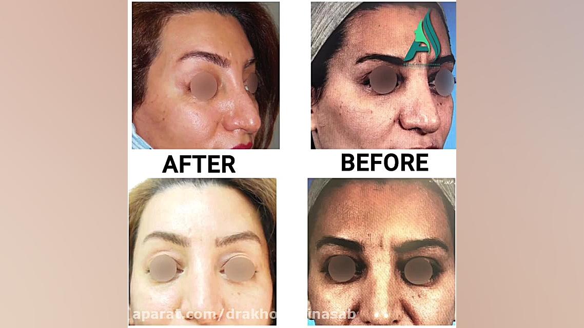 اصلاح خط اخم با لیفت آندوسکوپی پیشانی دکتر محمدرضا آخوندی نسب-فوق تخصص جراحی پلاستیک
