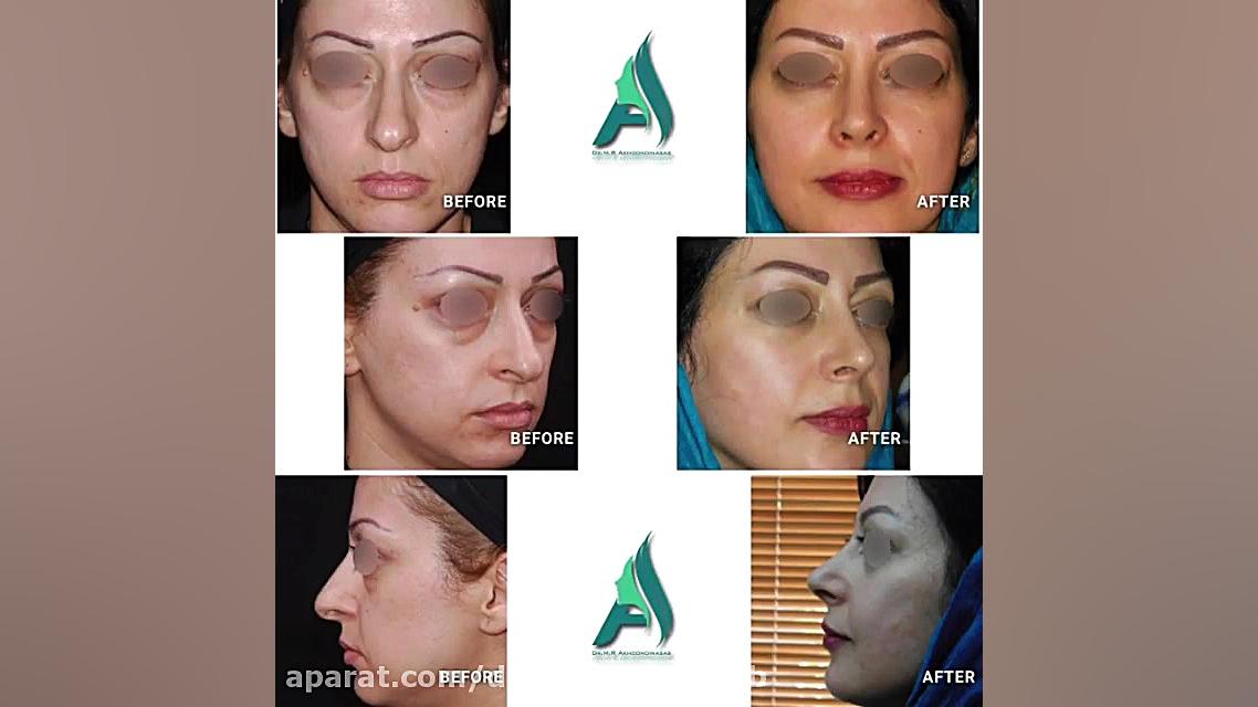 4 سال پس از جراحی بینی استخوانی دکتر محمدرضا آخوندی نسب-فوق تخصص جراحی پلاستیک