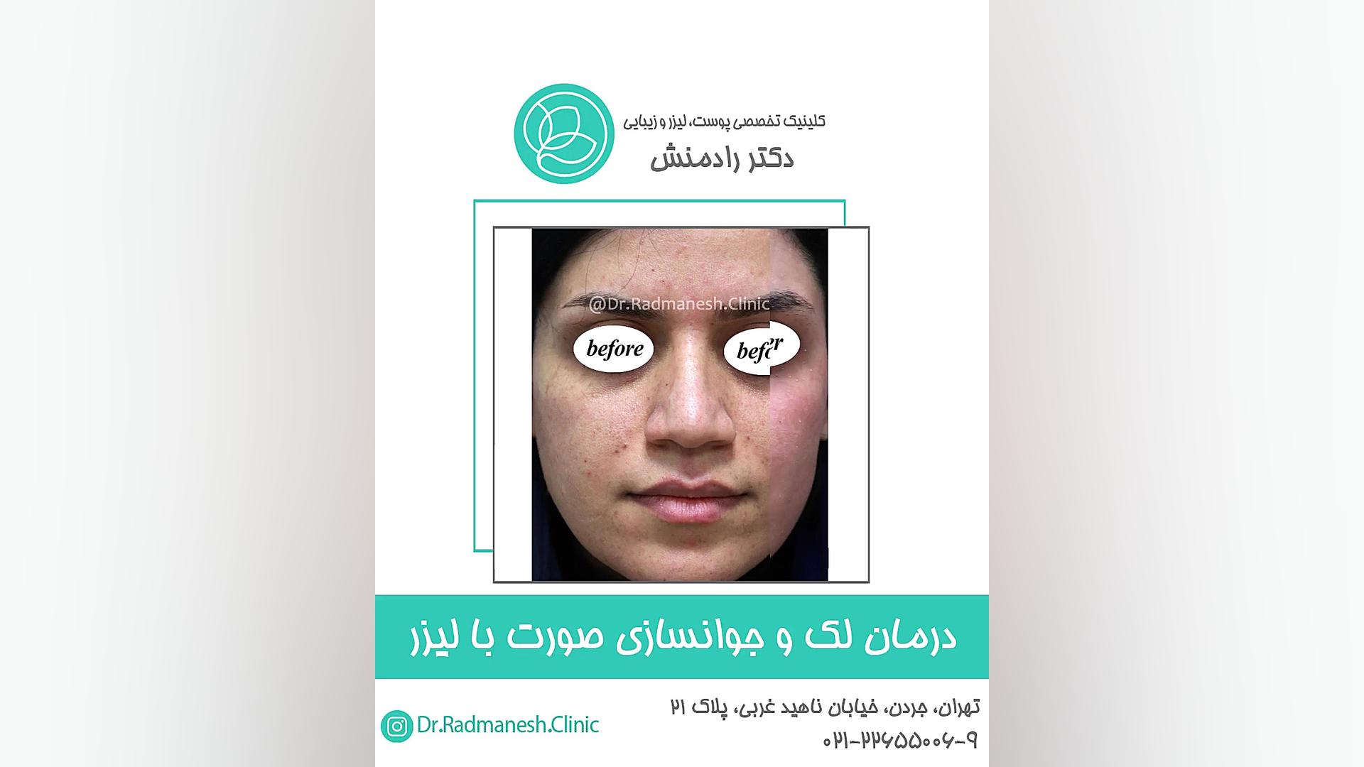 درمان لک و جوانسازی صورت با لیزر جرمگیری
