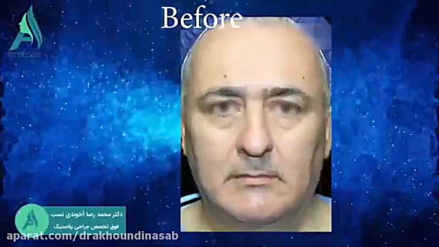 لیفت پیشانی دکتر محمدرضا آخوندی نسب-فوق تخصص جراحی پلاستیک