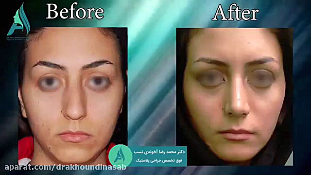 جراحی همزمان بینی و چانه دکتر محمدرضا آخوندی نسب-فوق تخصص جراحی پلاستیک