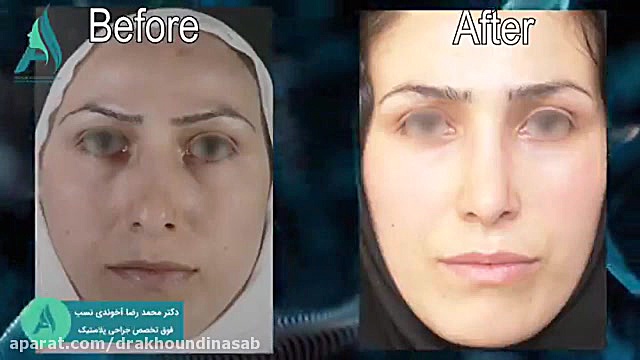 جراحی طبیعی بینی دکتر محمدرضا آخوندی نسب-فوق تخصص جراحی پلاستیک