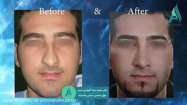 جراحی زیبایی بینی دکتر محمدرضا آخوندی نسب-فوق تخصص جراحی پلاستیک