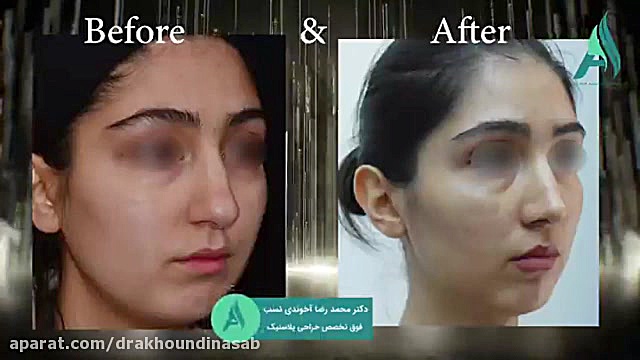 جراحی زیبایی بینی طبیعی دکتر محمدرضا آخوندی نسب-فوق تخصص جراحی پلاستیک