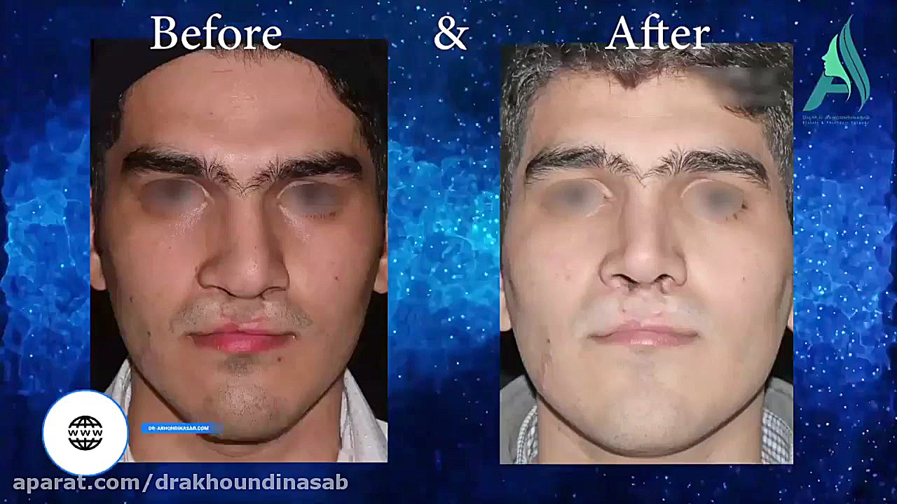 جراحی زیبایی بینی در بیمار لب شکری دکتر محمدرضا آخوندی نسب-فوق تخصص جراحی پلاستیک