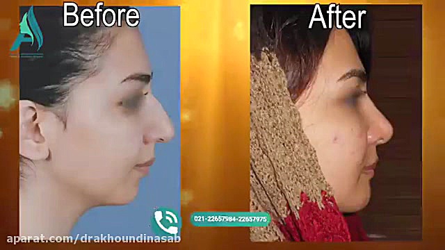 جراحی چانه و بینی همزمان دکتر محمدرضا آخوندی نسب-فوق تخصص جراحی پلاستیک