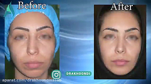جراحی چانه و بینی به طور همزمان دکتر محمدرضا آخوندی نسب-فوق تخصص جراحی پلاستیک