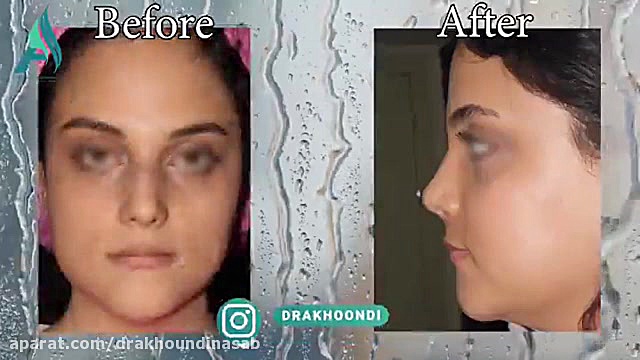 جراحی بینی نیمه فانتزی دکتر محمدرضا آخوندی نسب-فوق تخصص جراحی پلاستیک