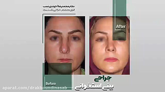جراحی بینی استخوانی دکتر محمدرضا آخوندی نسب-فوق تخصص جراحی پلاستیک