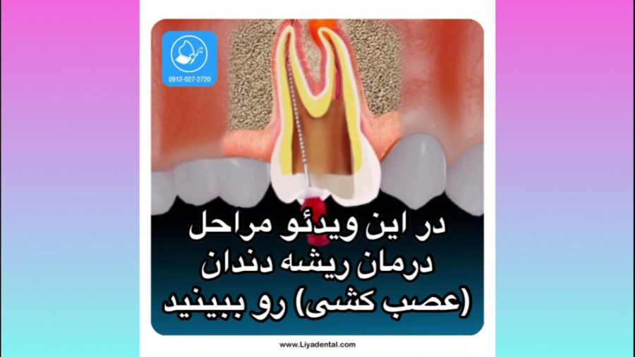 عصب کشی دندان (درمان ریشه) در کلینیک دندانپزشکی لیا تزریق بوتاکس