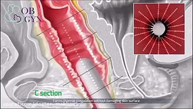 درمان عفونت و خشکی واژن با هایفوتراپی پزشکی میکروRNA
