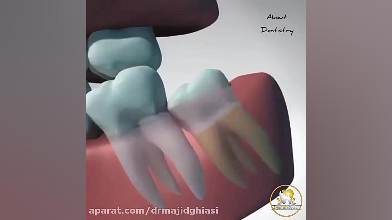 جراحی دندان عقل نهفته دکترمجیدقیاسی