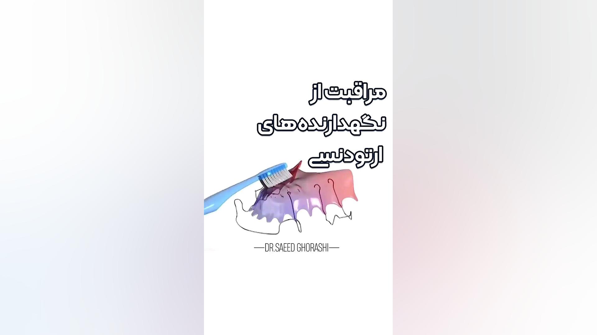 ریتینرها تاثیر مهمی در حفظ نتیجه درمان ارتودنسی دارند.دکترعلیرضاخدیوی دکتر علیرضا خدیوی