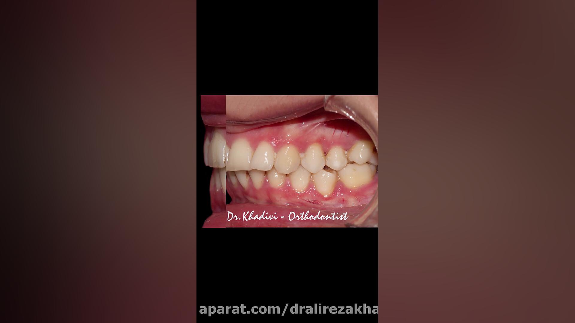 ارتودنسی ثابت دو فک همراه با کشیدن دندان در فک بالا.دکترعلیرضاخدیوی دکتر علیرضا خدیوی