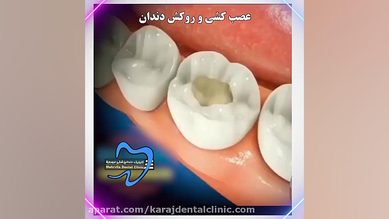 عصب کشی و روکش دندان Southern Blot