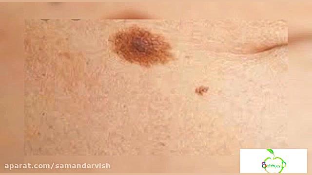 علائم ظاهری سرطان پوست | به آیند لیپوست
