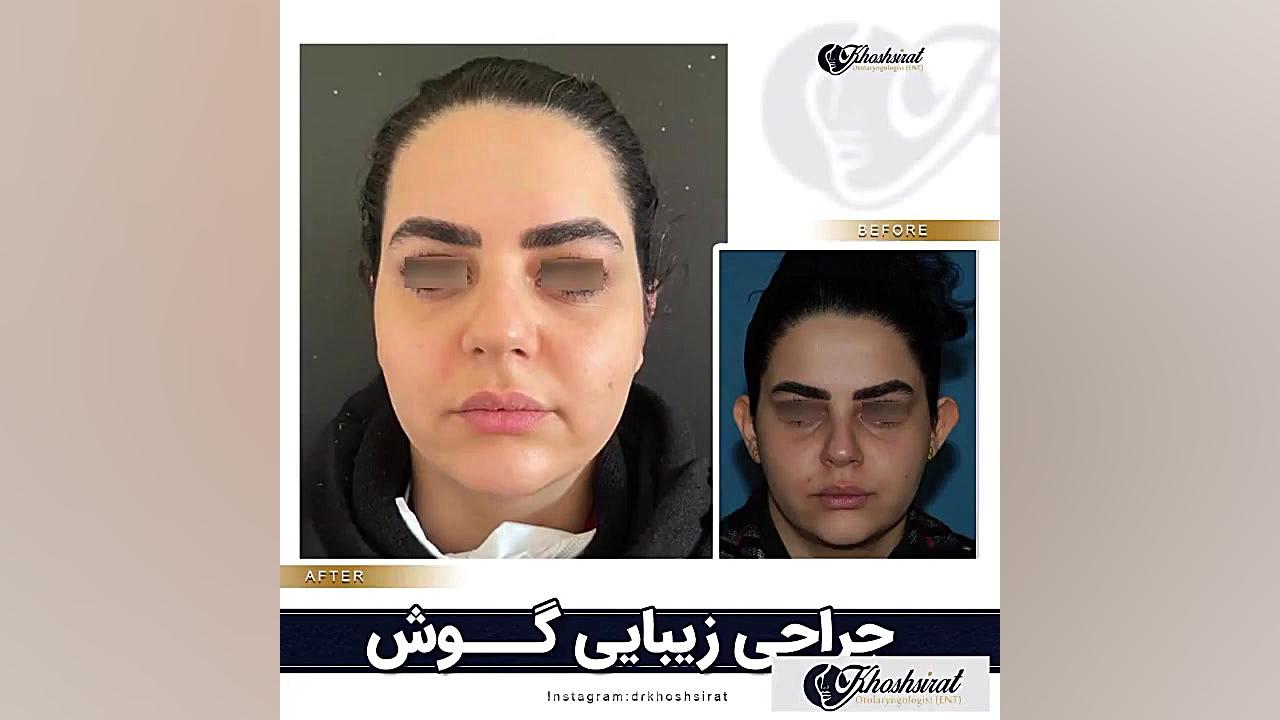 جراحی زیبایی گوش ( اتوپلاستی ) | دکتر شاهرخ خوش سیرت FEV1