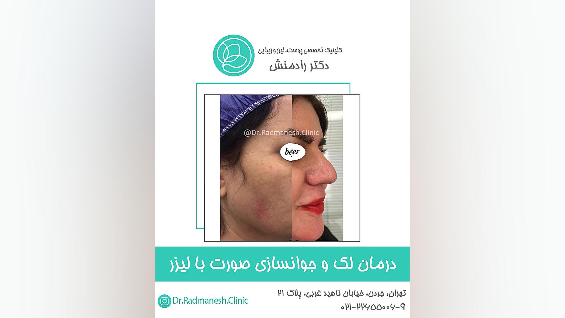 درمان لک و جوانسازی صورت با لیزر پالپوتومی