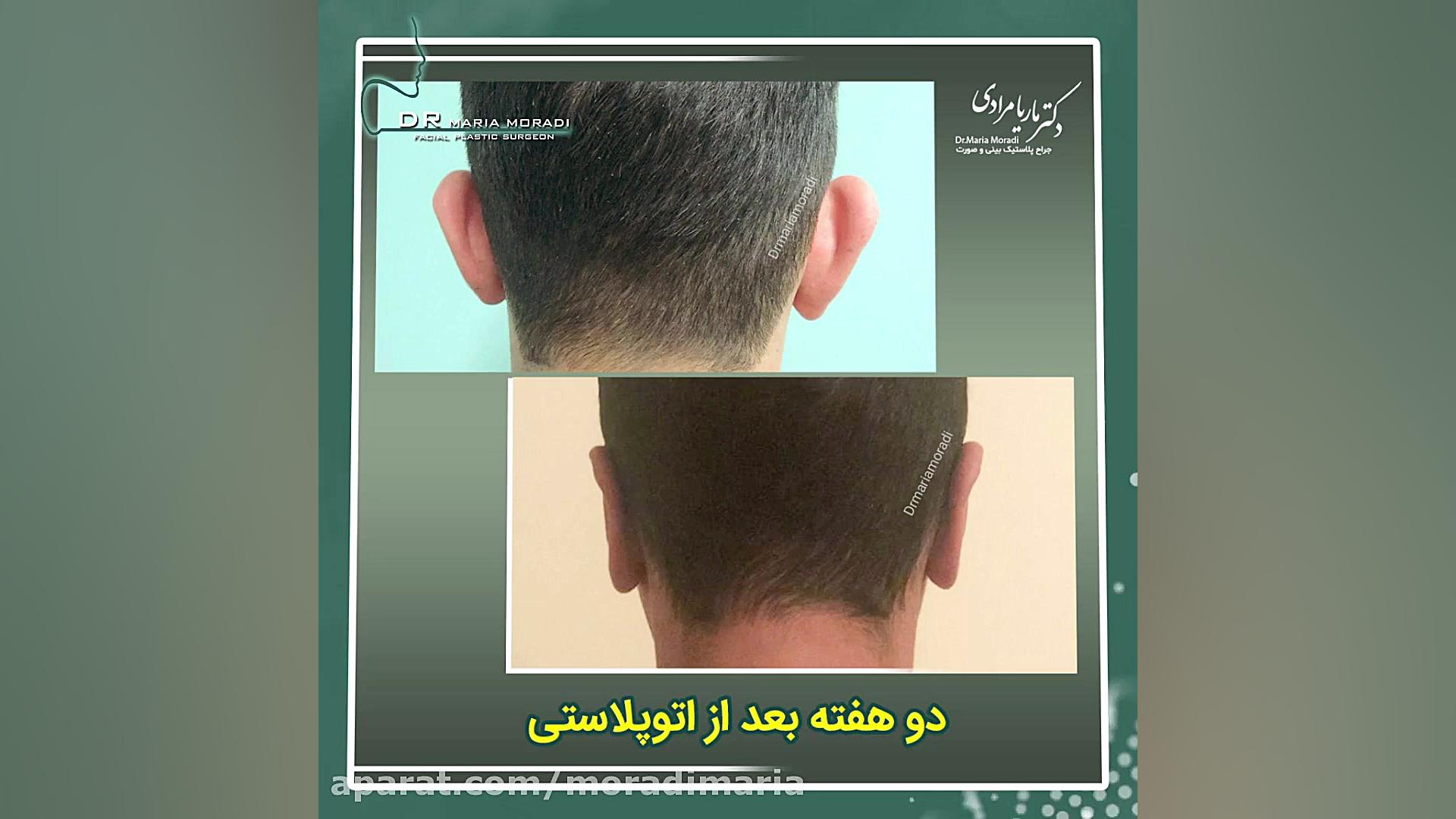 دو هفته پس از اتوپلاستی یا جراحی زیبایی گوش | دکتر ماریا مرادی بلیچینگ دندان