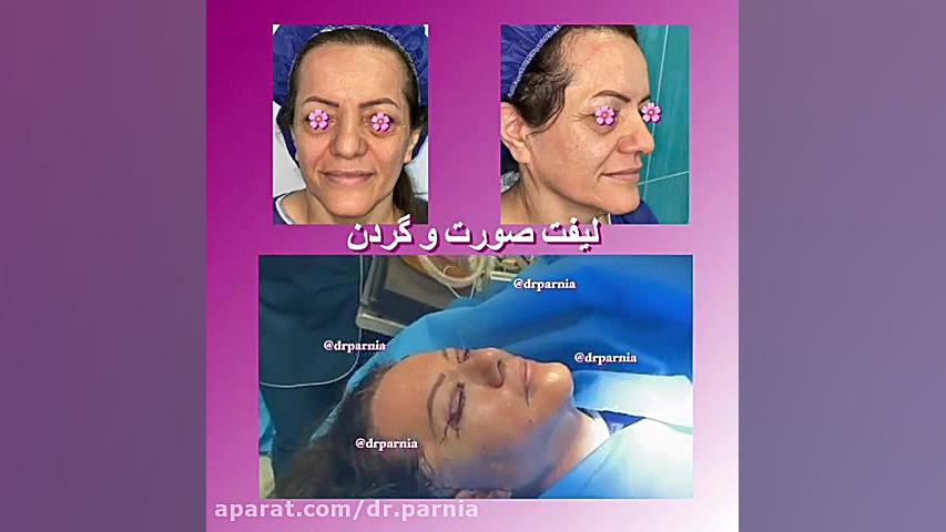 ليفت صورت و گردن دکتر رفیع پرنیا فوق تخصص پلاستیک