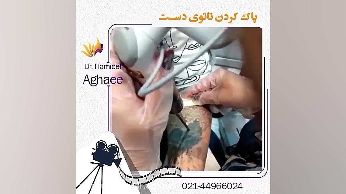 پاک کردن تتو با لیزر دکتر حمیده آقایی