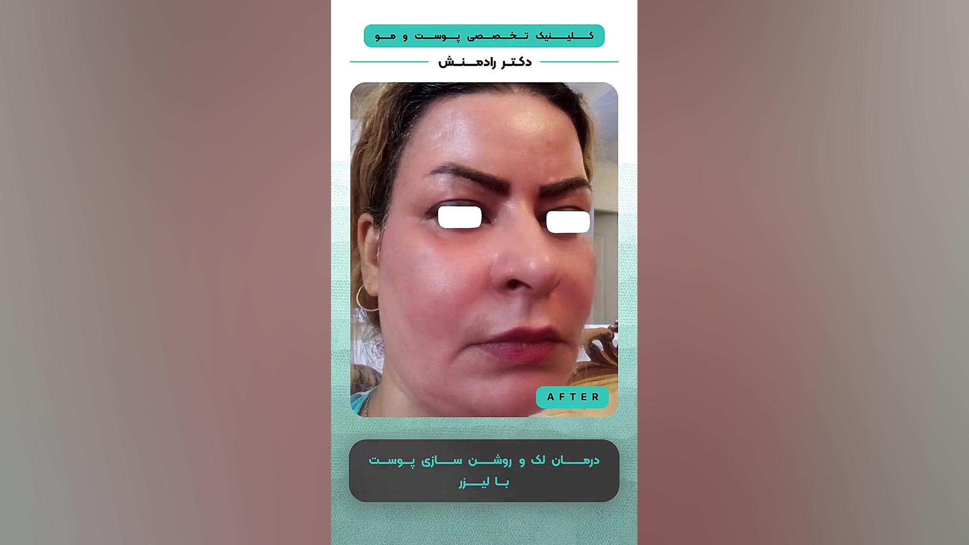 درمان لک و روشن سازی پوست با لیزر اینسایزینگ