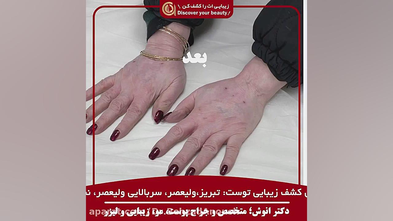 قبل و بعد تزریق چربی دست دکتر بهزاد انوش|متخصص و جراح پوست مو زیبایی و لیزر