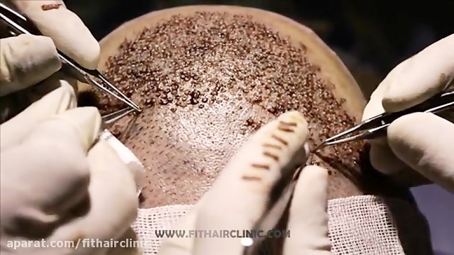 بالاترین تراکم کاشت مو ( حتما ببینید) دکتر مهدی ایزدی