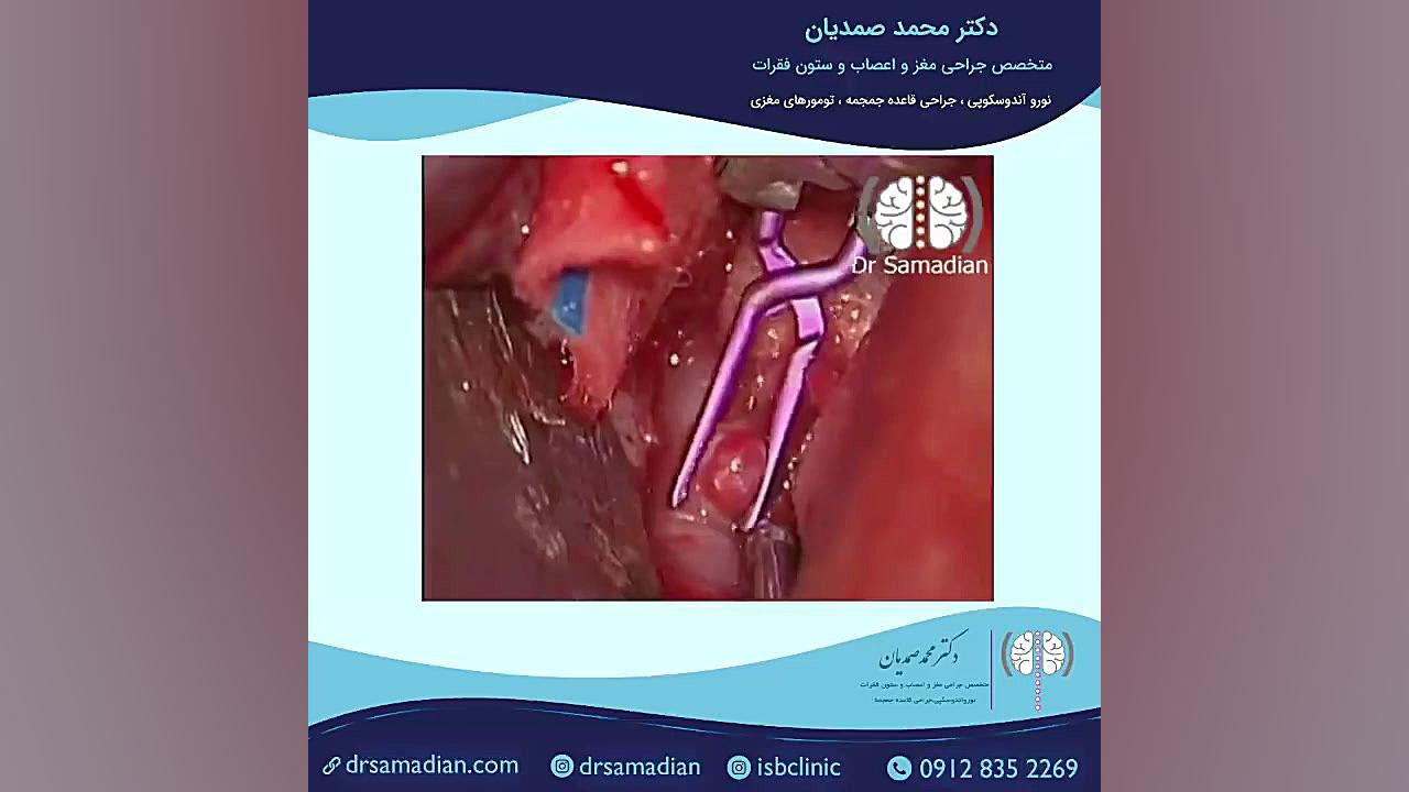 عمل جراحی آنوریسم شریان مغزی دندان پیش