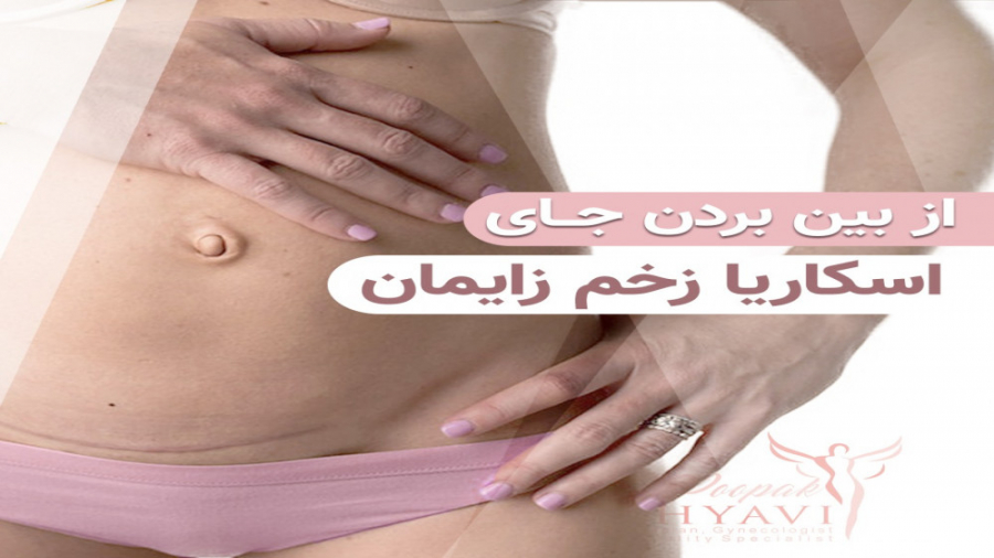 فیلم ازبین بردن جای زخم و اسکار زایمان با کمک کربوکسی تراپی و دی بی دی کامپوزیت ونیر