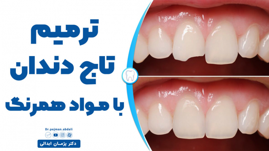 ترمیم تاج دندان با مواد همرنگ تزریق چربی