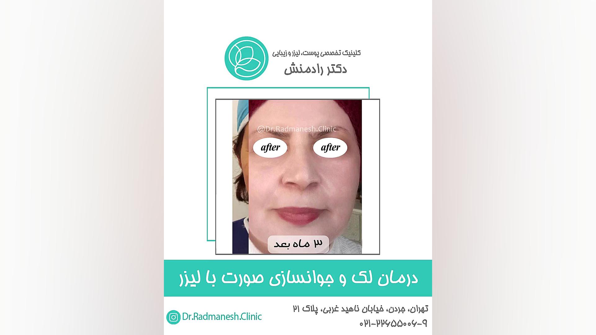 درمان لک و جوانسازی صورت با لیزر پاکسازی پوست