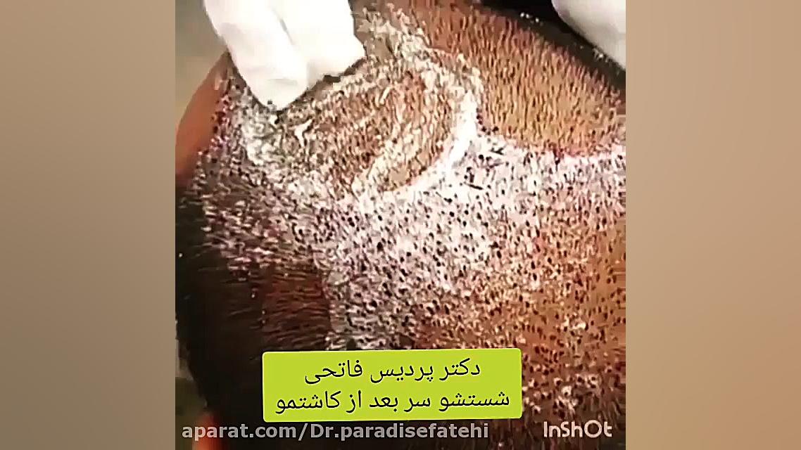 شستشوی مو بعد از کاشت مو ویروس‌شناسی پیشرفته