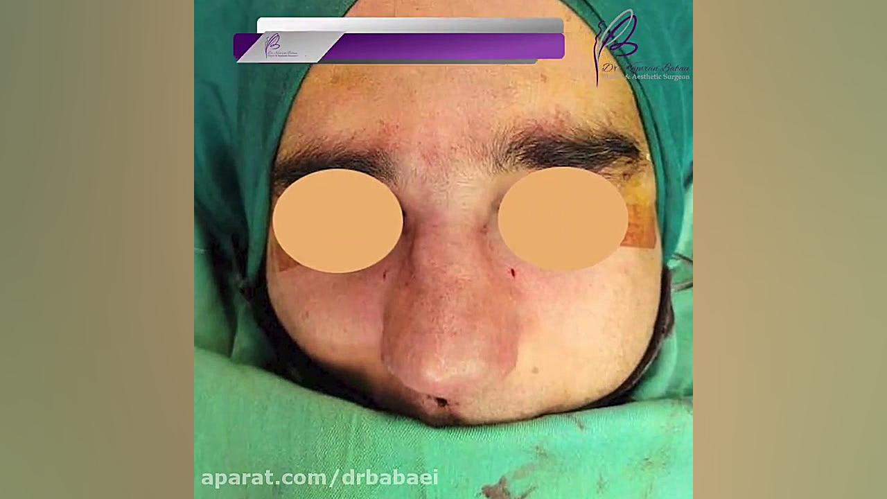 جراحی زیبایی بینی گوشتی با قوز شدید در آقایان دکتر کامران بابایی