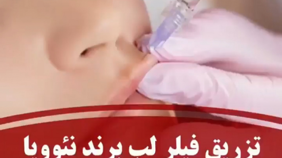 تزریق فیلر لب برند نئوویا دکتر بهزاد انوش|متخصص و جراح پوست مو زیبایی و لیزر