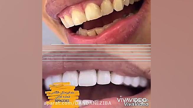 باندینگ دندان فیلم بلیچینگ دندان جرمگیری و بروساژ دندان اکستنشن تاج دندان