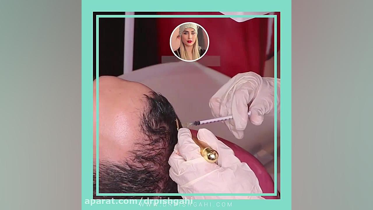 فیلم مزوتراپی مو بیماری کارنی تین ناقل نقص اولیه