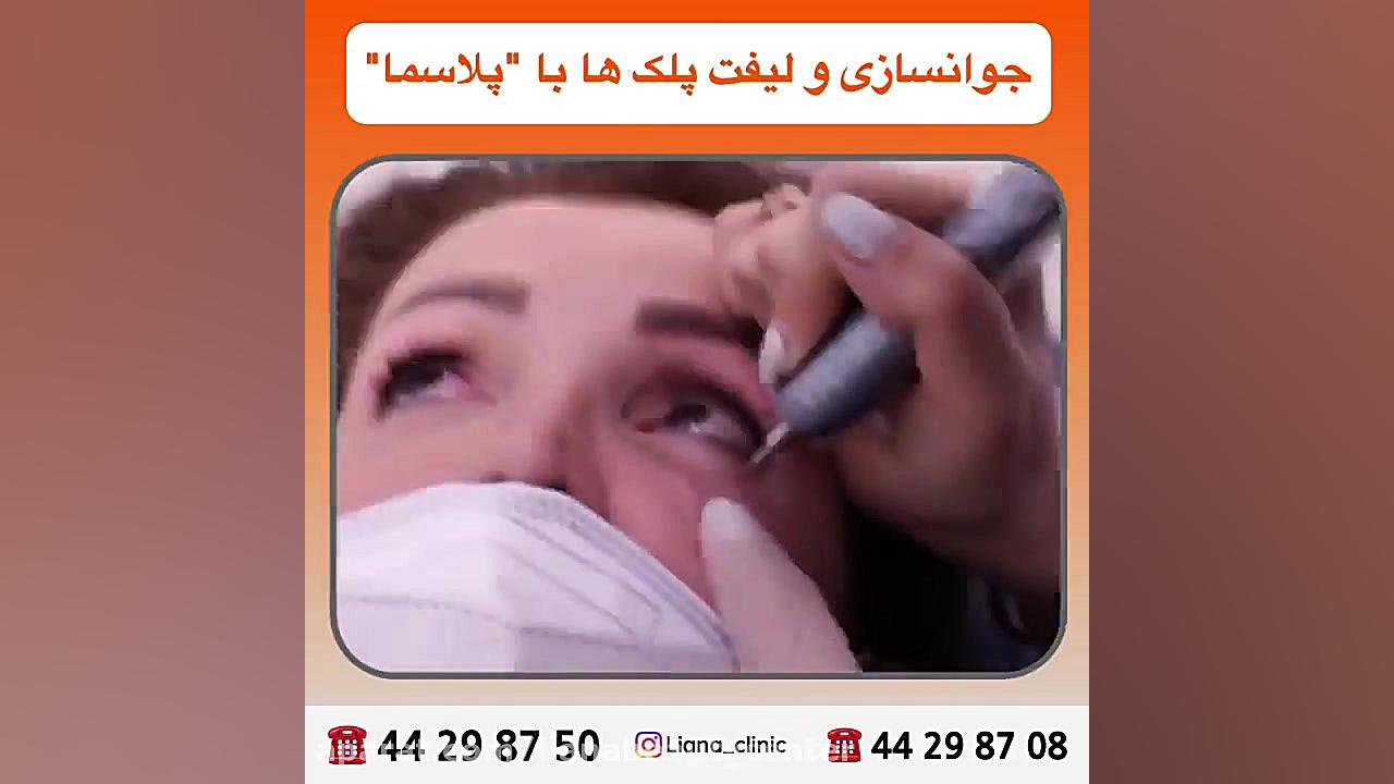 جوانسازی و لیفت پلک ها با پلاسما TAVI