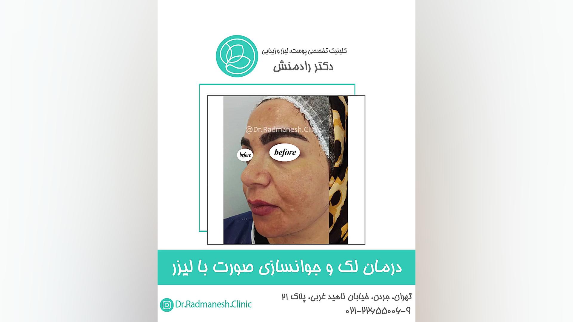 درمان لک و جوانسازی صورت با لیزر زاویه سازی صورت