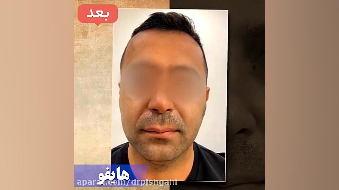 تغییرات قبل و بعد از هایفوتراپی صورت DLCO