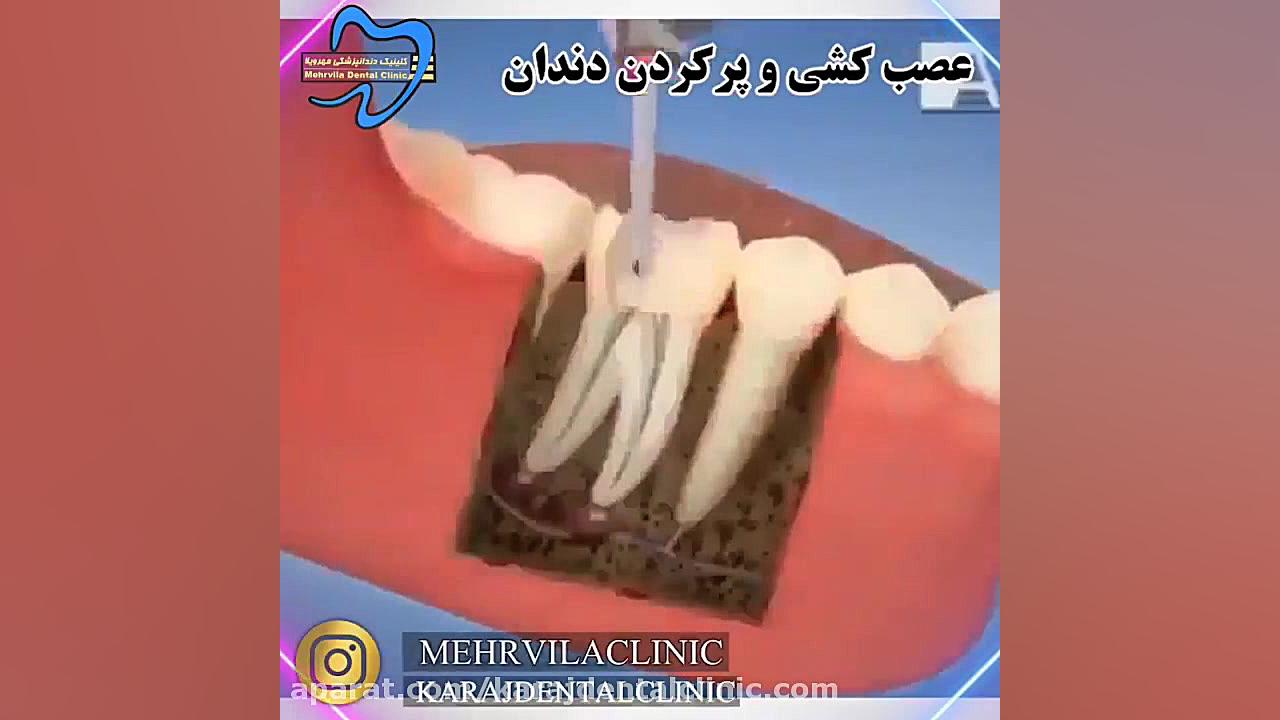 عصب کشی و پر کردن دندان اولتراسوند پرتابل جیبی