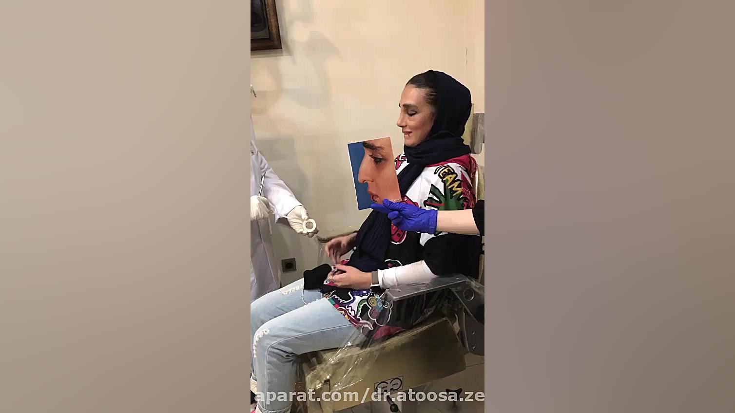 چسب زدن بینی پس از عمل زیبایی بینی هایپوفلکسی