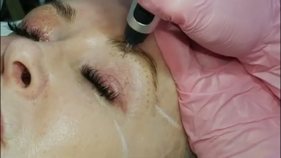 آموزش کار با پلاسما پن پلاسماتراپی فروش دستگاه 02188980794 جوانسازی پوست