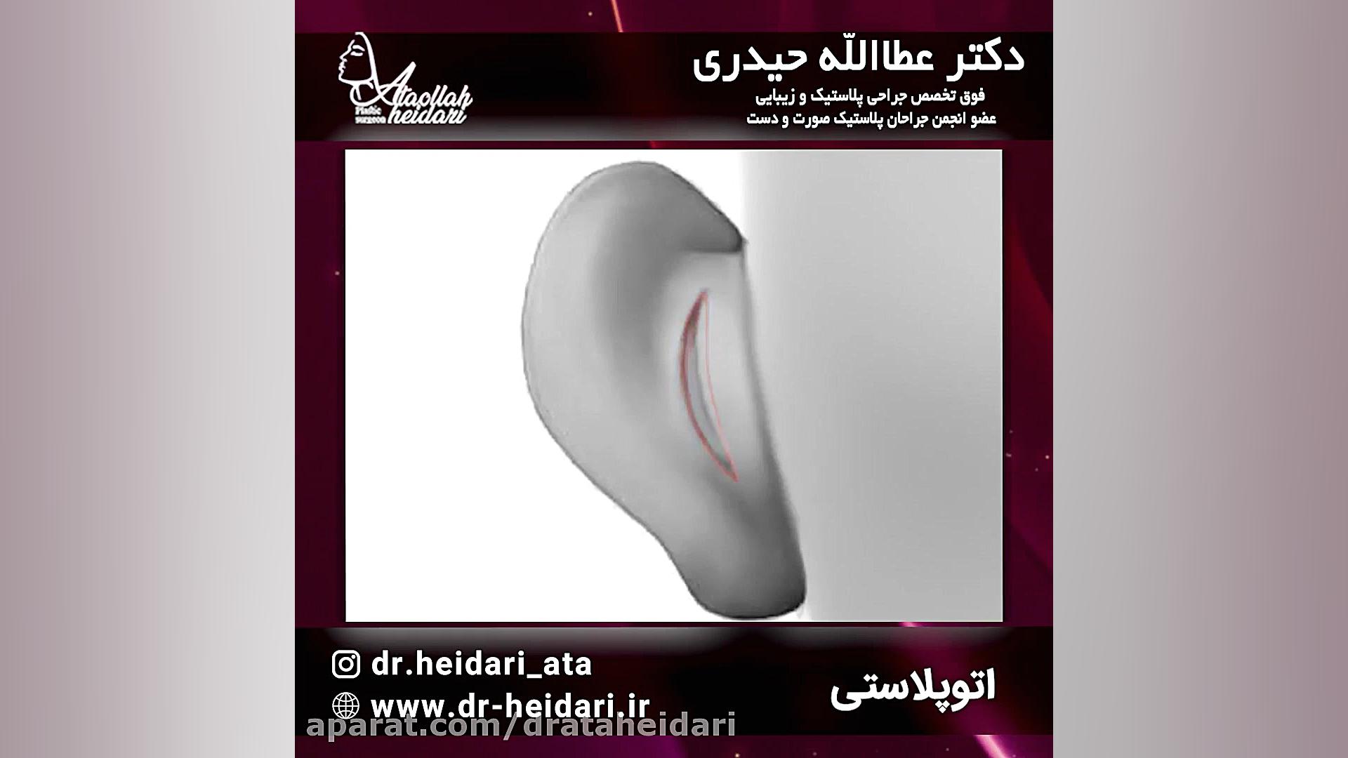 اتوپلاستی یا جراحی زیبایی گوش پلاستیک لثه