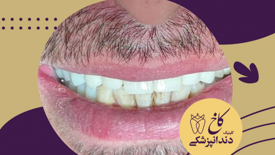 لبخند زیبا با کلینیک کاخ کلینیک دندانپزشکی کاخ