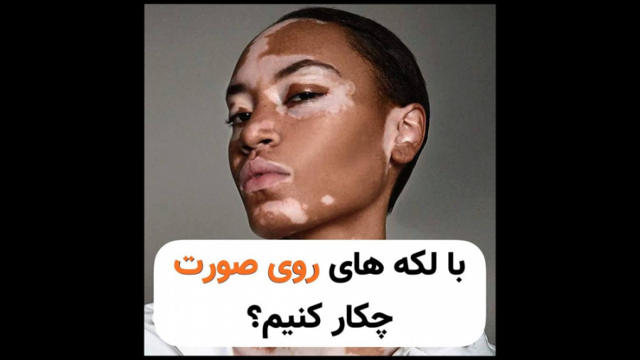 با لک و پیس روی صورت چیکار کنیم؟ ویتیلیگو برص دیگو مارادونا