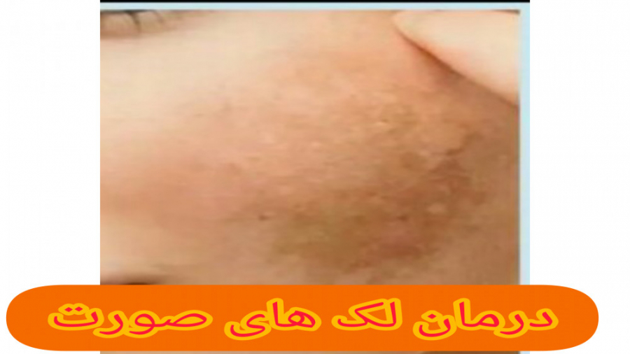 چگونه لک های صورت را درمان کنیمم؟؟؟ رادیوگرافی دندان