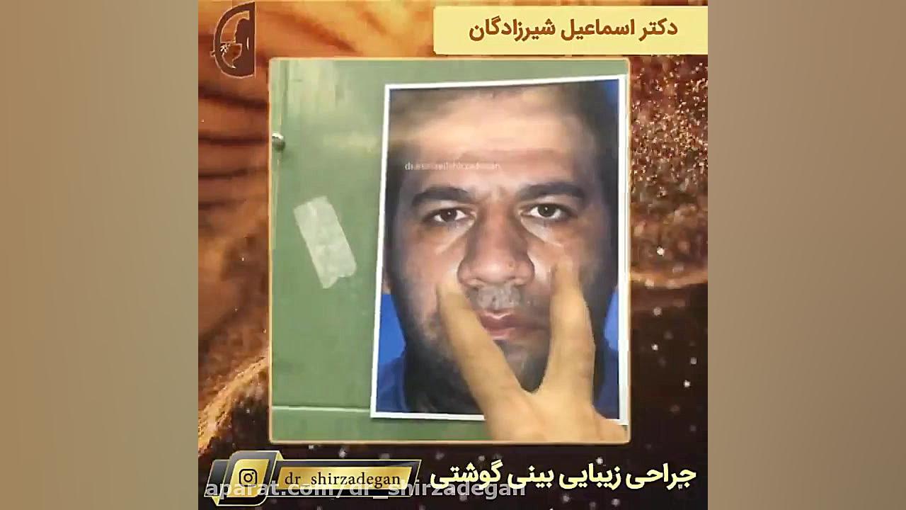 جراحی بینی گوشتی مردانه دکتر اسماعیل شیرزادگان